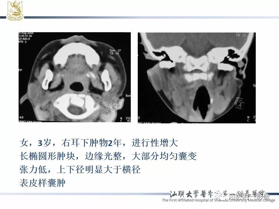 【PPT】腮腺病变CT诊断-64
