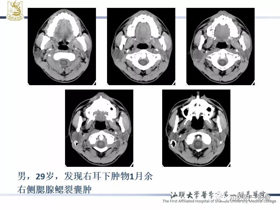 【PPT】腮腺病变CT诊断-65