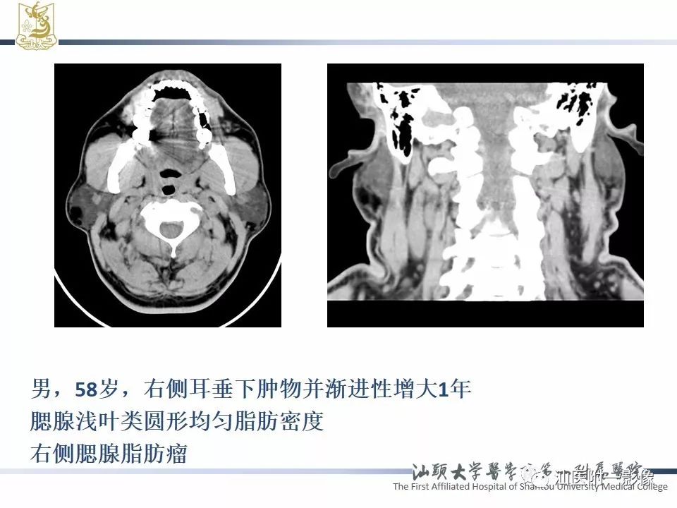 【PPT】腮腺病变CT诊断-66