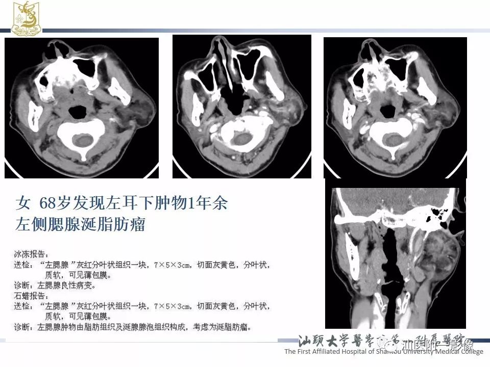 【PPT】腮腺病变CT诊断-67