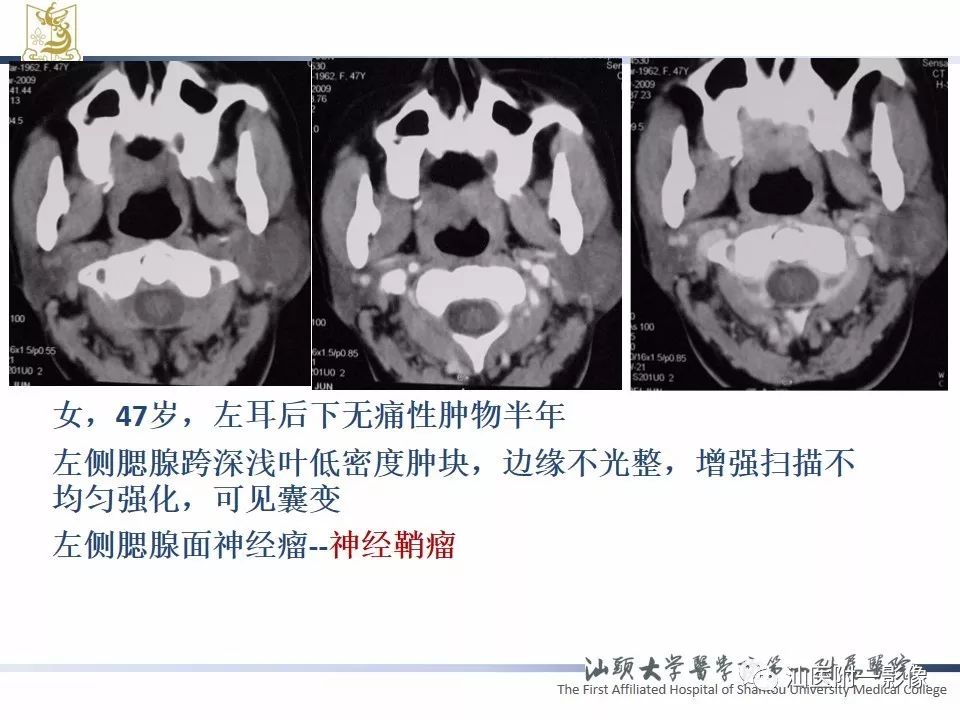 【PPT】腮腺病变CT诊断-68