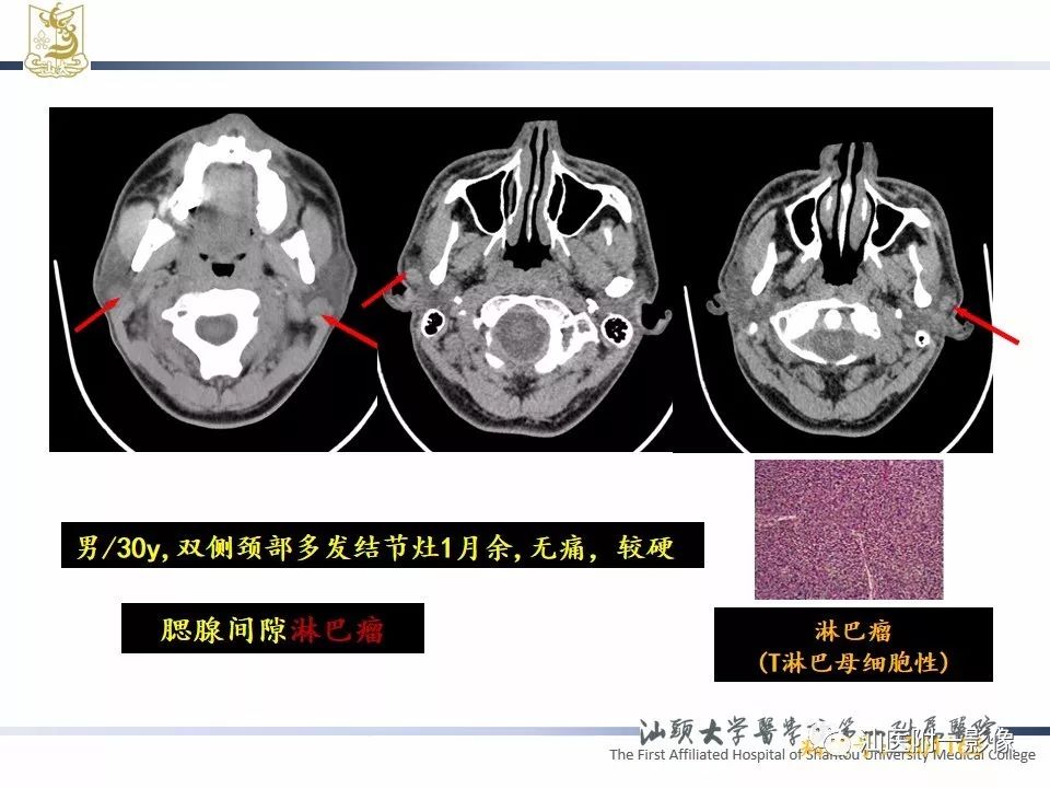 【PPT】腮腺病变CT诊断-69