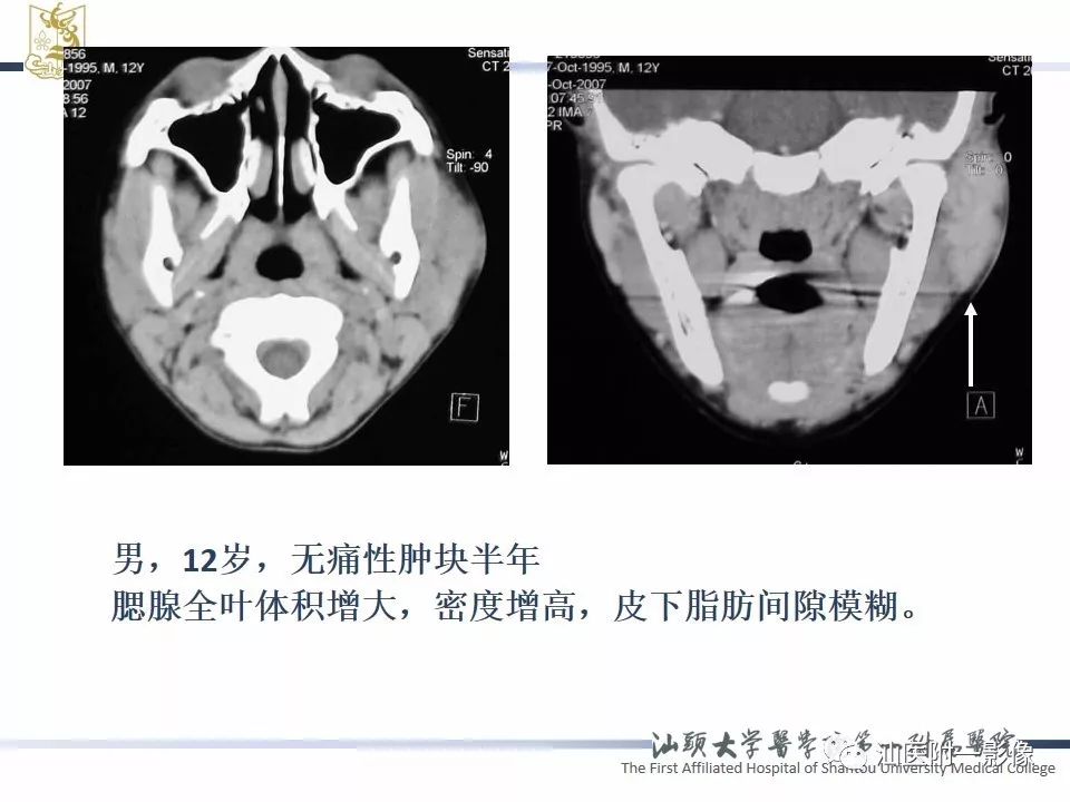 【PPT】腮腺病变CT诊断-72