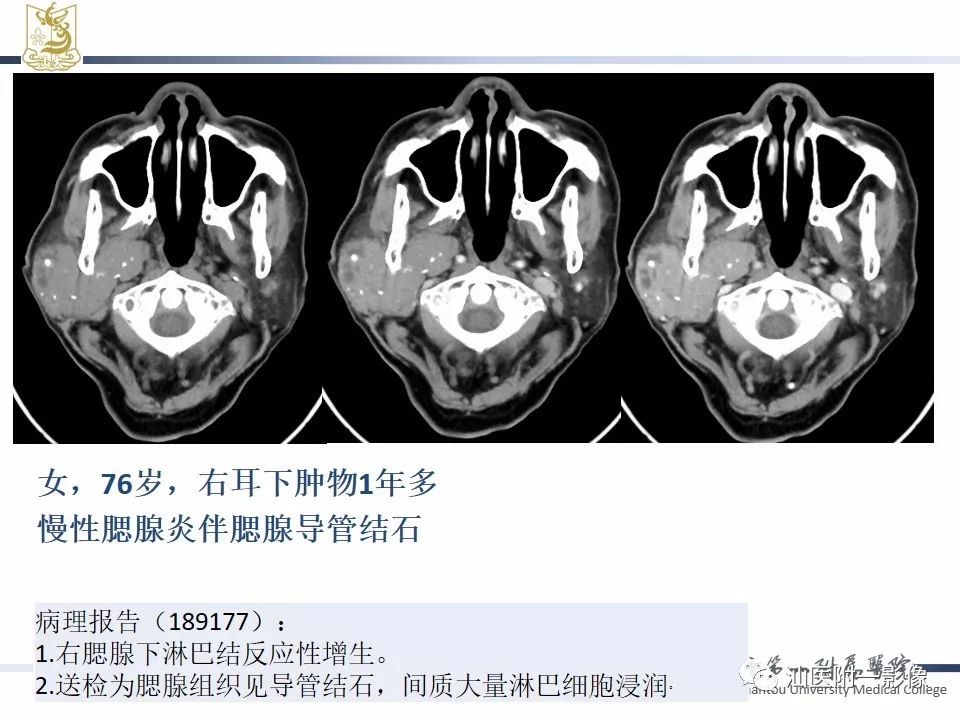 【PPT】腮腺病变CT诊断-73