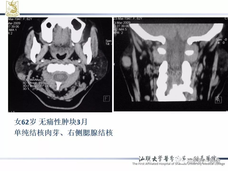 【PPT】腮腺病变CT诊断-75