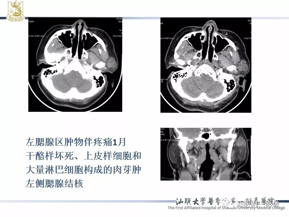 【PPT】腮腺病变CT诊断-76