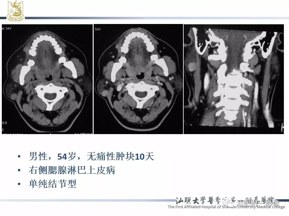 【PPT】腮腺病变CT诊断-78