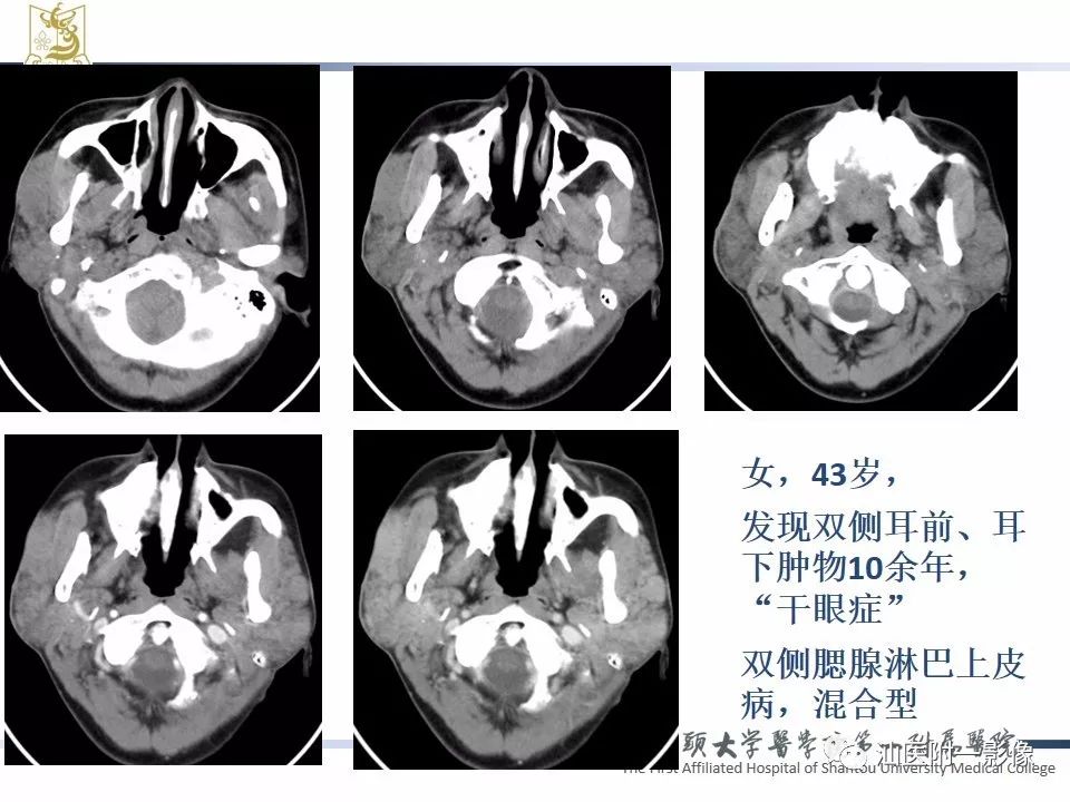 【PPT】腮腺病变CT诊断-79