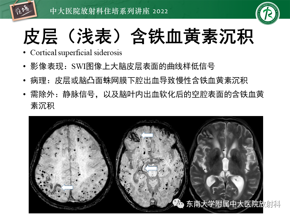 【PPT】脑小血管病概念、影像维度及其深度学习进展-13