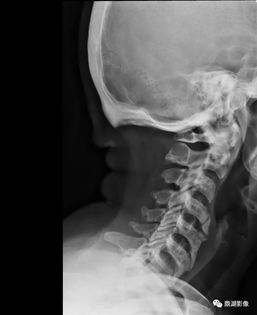 这椎体不是“骨质增生”也非“强直”，别误诊了-3