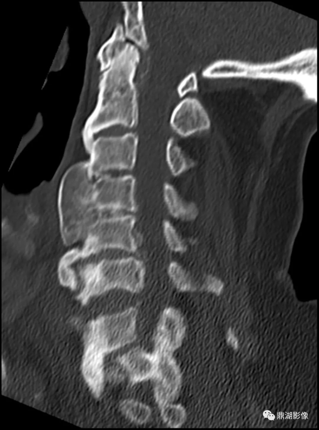 这椎体不是“骨质增生”也非“强直”，别误诊了-4