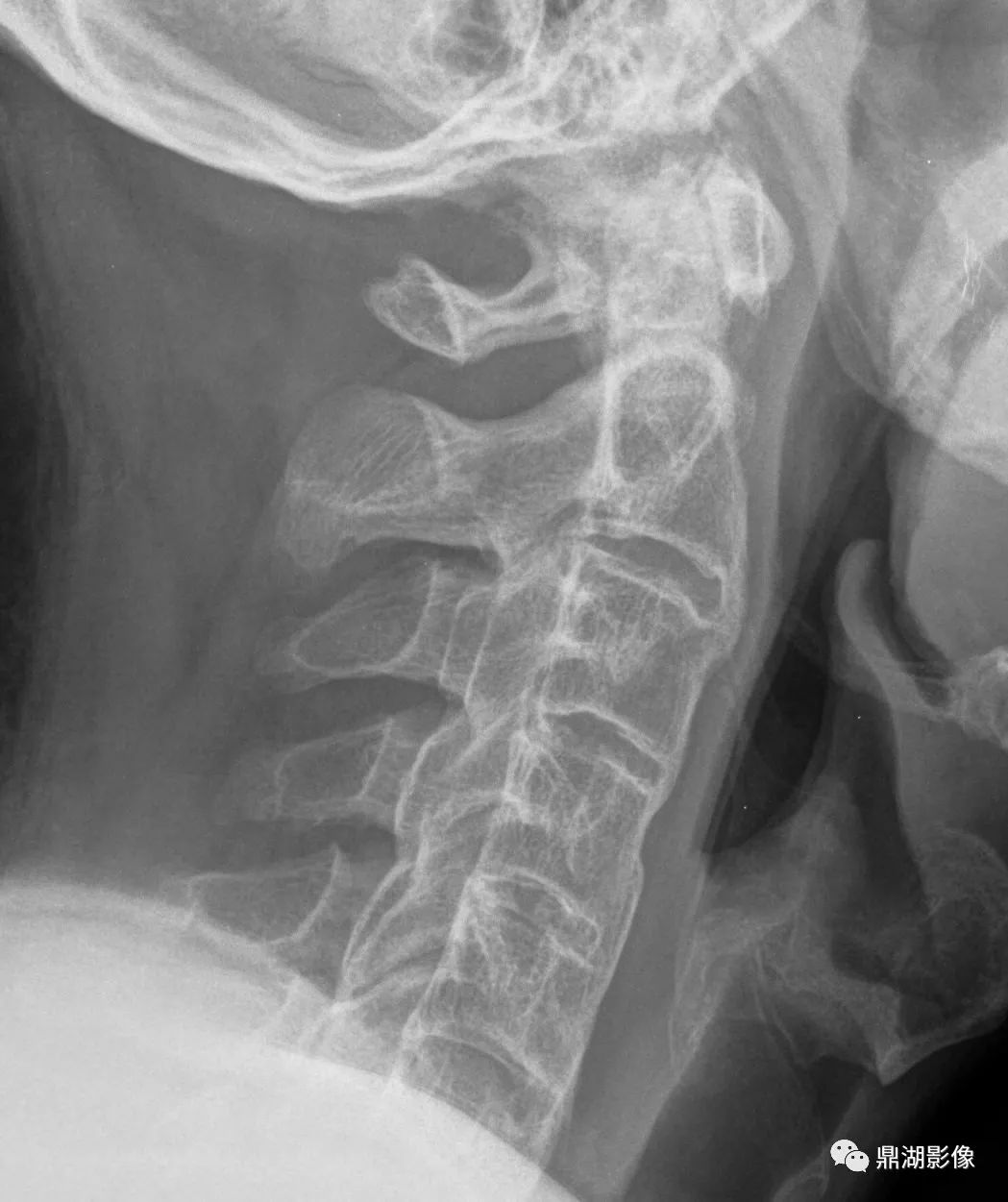 这椎体不是“骨质增生”也非“强直”，别误诊了-2