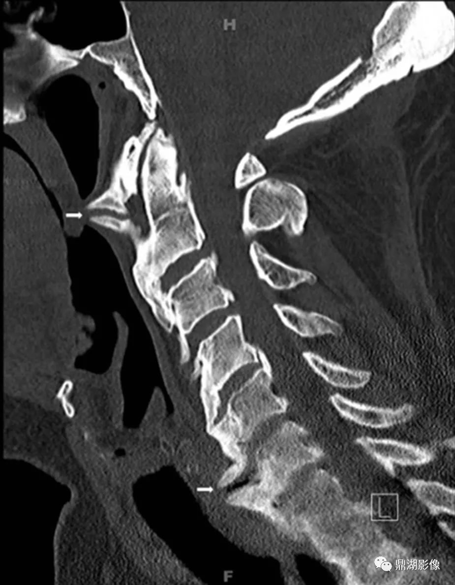 这椎体不是“骨质增生”也非“强直”，别误诊了-1
