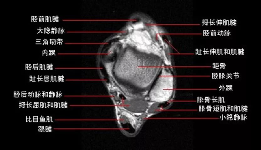 踝关节MRI解剖及7种常见损伤类型影像表现-4