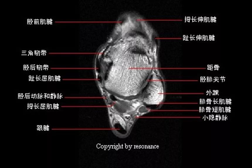 踝关节MRI解剖及7种常见损伤类型影像表现-5