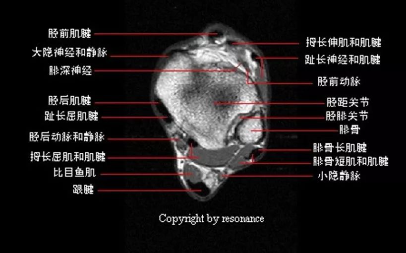 踝关节MRI解剖及7种常见损伤类型影像表现-3