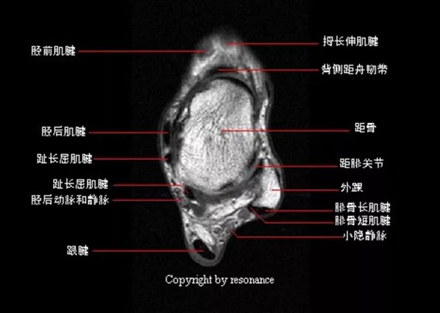 踝关节MRI解剖及7种常见损伤类型影像表现-6