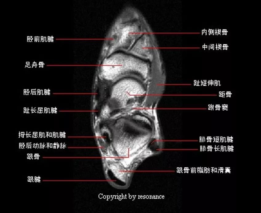 踝关节MRI解剖及7种常见损伤类型影像表现-7