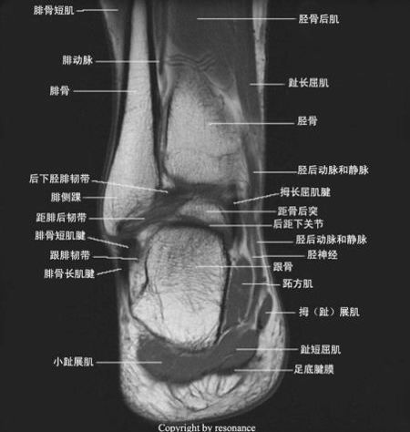踝关节MRI解剖及7种常见损伤类型影像表现-9