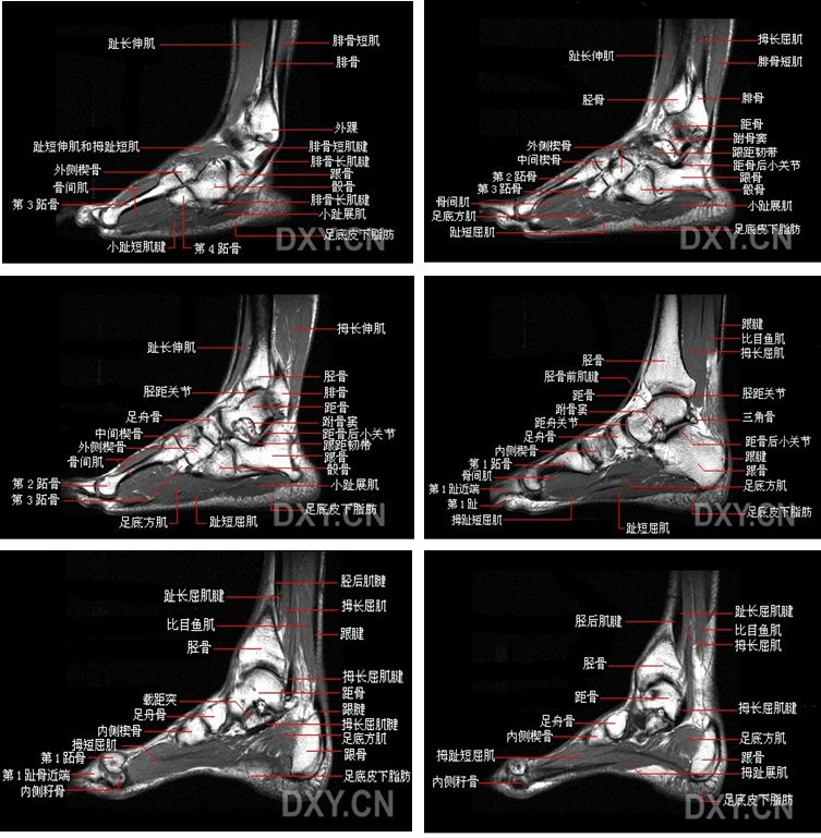 踝关节MRI解剖及7种常见损伤类型影像表现-8