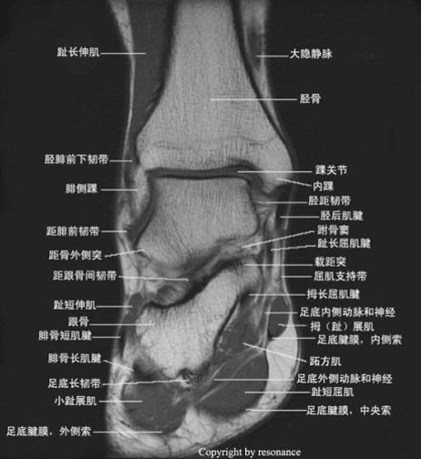 踝关节MRI解剖及7种常见损伤类型影像表现-11