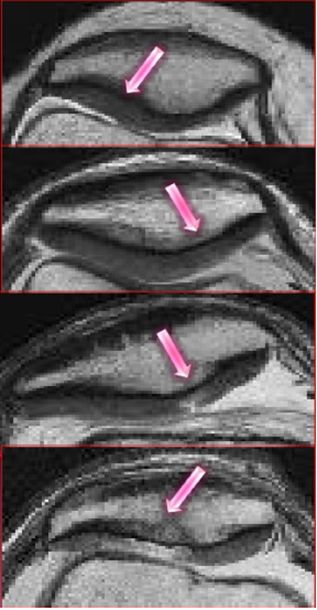 踝关节MRI解剖及7种常见损伤类型影像表现-14