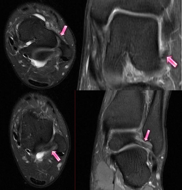 踝关节MRI解剖及7种常见损伤类型影像表现-20