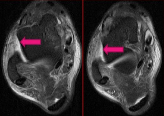 踝关节MRI解剖及7种常见损伤类型影像表现-22