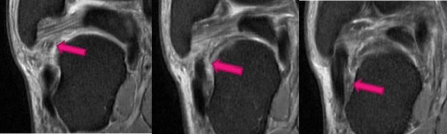 踝关节MRI解剖及7种常见损伤类型影像表现-24