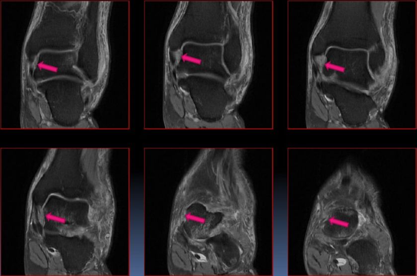 踝关节MRI解剖及7种常见损伤类型影像表现-26