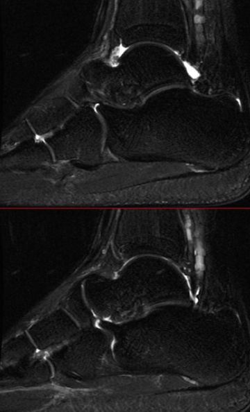 踝关节MRI解剖及7种常见损伤类型影像表现-28