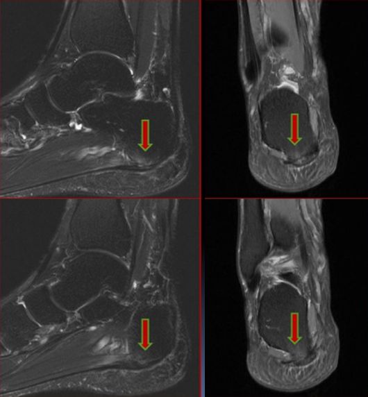 踝关节MRI解剖及7种常见损伤类型影像表现-30