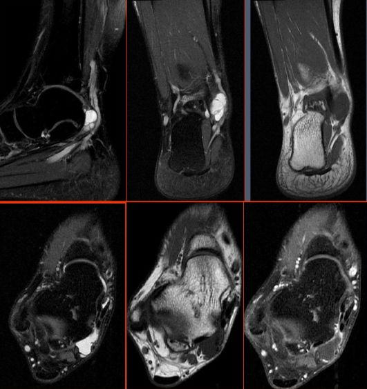 踝关节MRI解剖及7种常见损伤类型影像表现-32