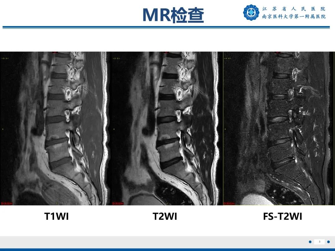 【PPT】终板炎-4