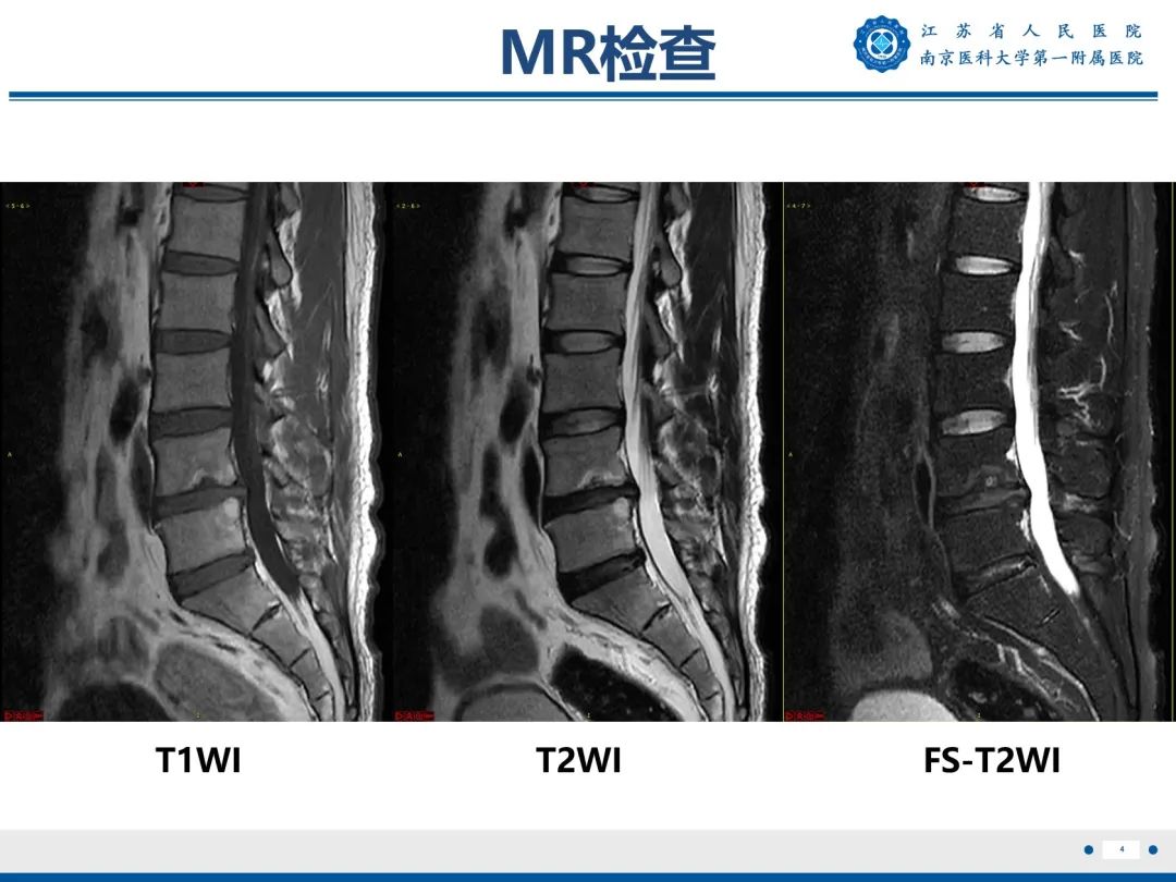 【PPT】终板炎-5