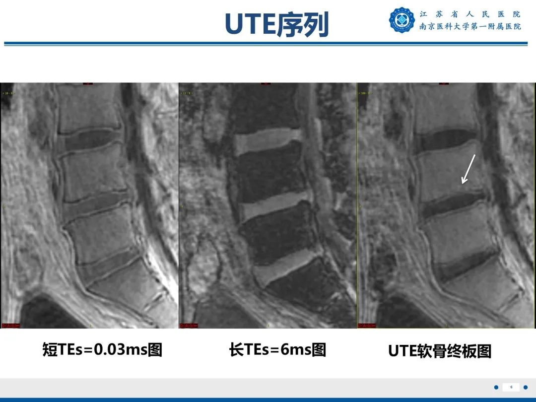 【PPT】终板炎-7