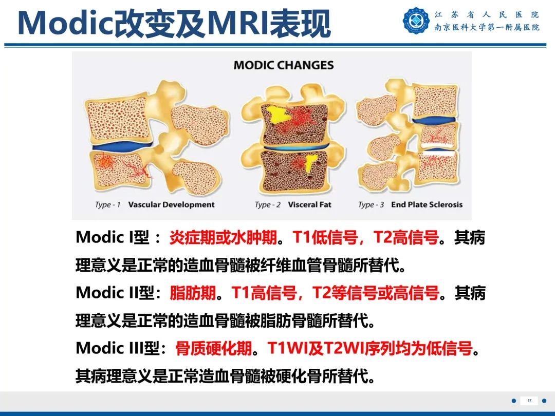 【PPT】终板炎-18