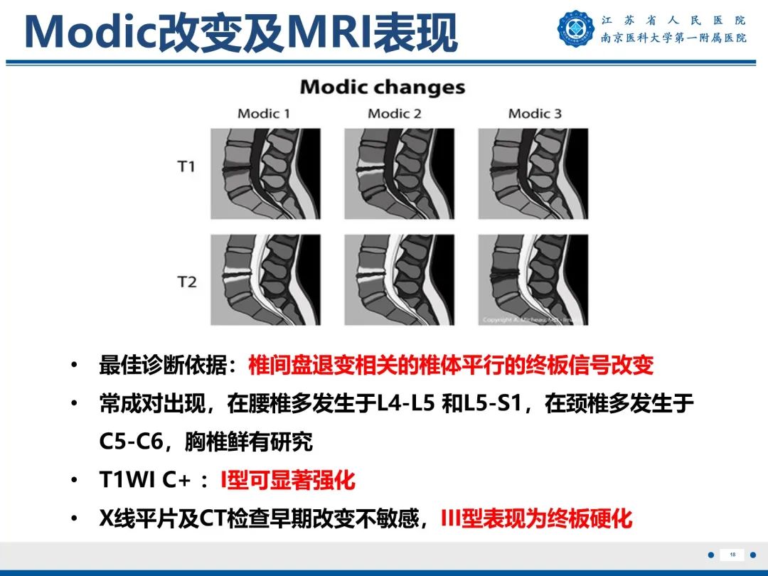 【PPT】终板炎-19