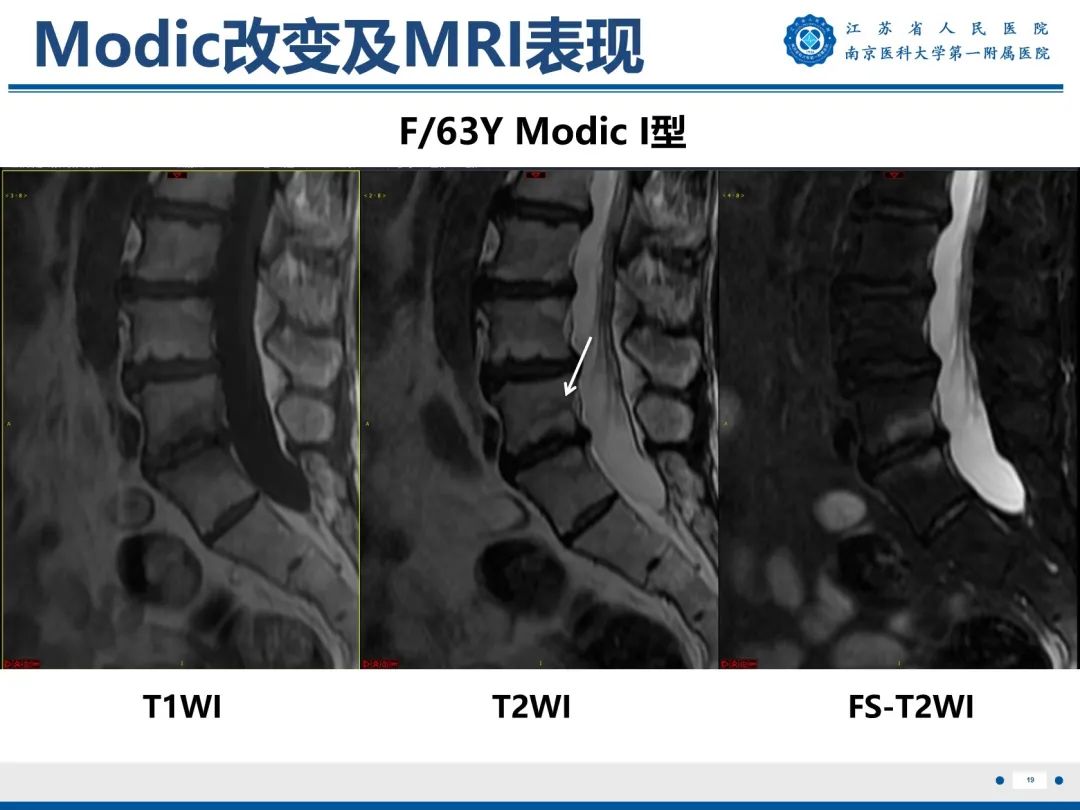 【PPT】终板炎-20