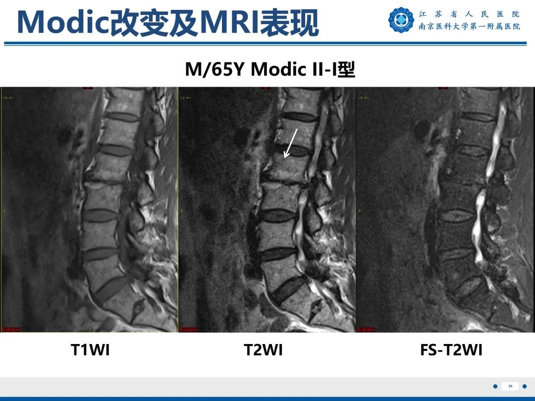 【PPT】终板炎-25