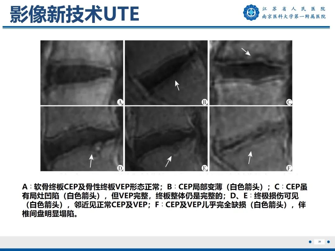 【PPT】终板炎-30