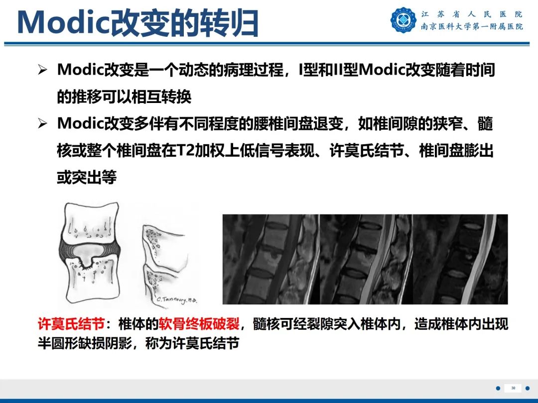 【PPT】终板炎-31