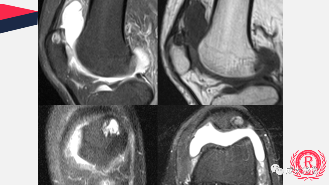 【PPT】剥脱性骨软骨炎-3