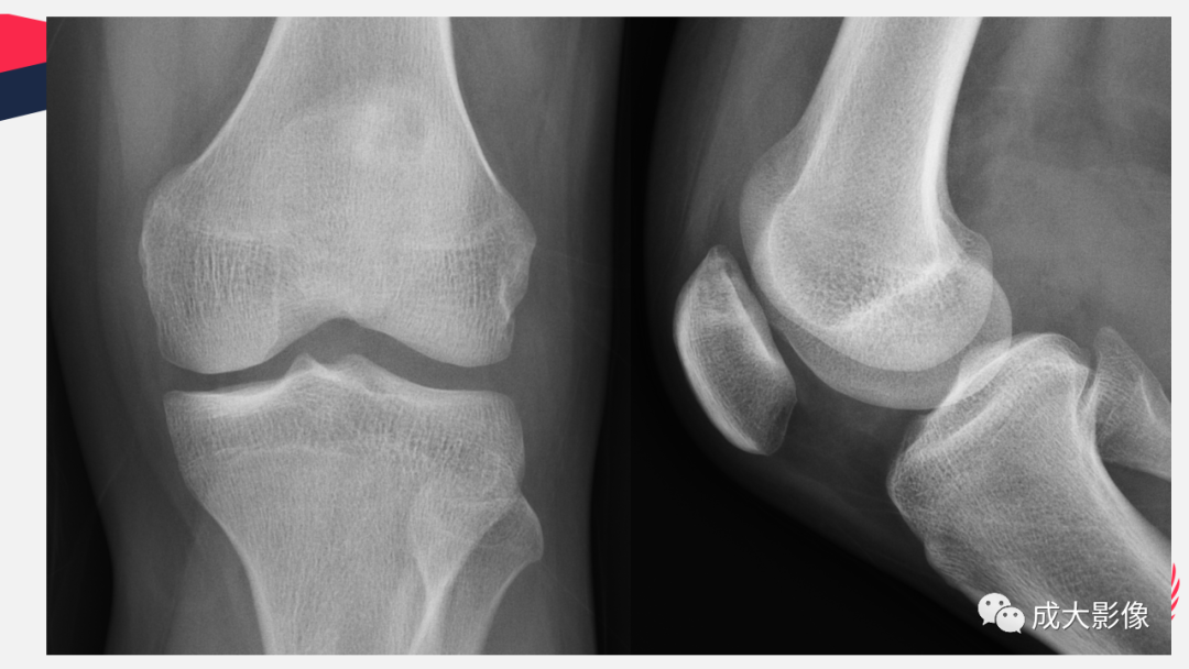 【PPT】剥脱性骨软骨炎-1