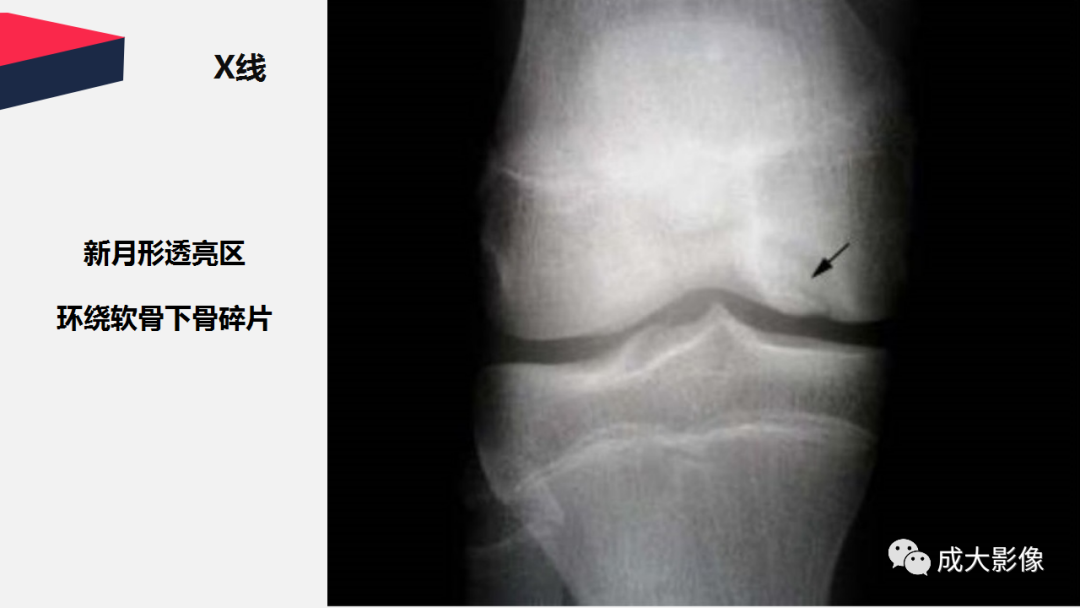 【PPT】剥脱性骨软骨炎-11