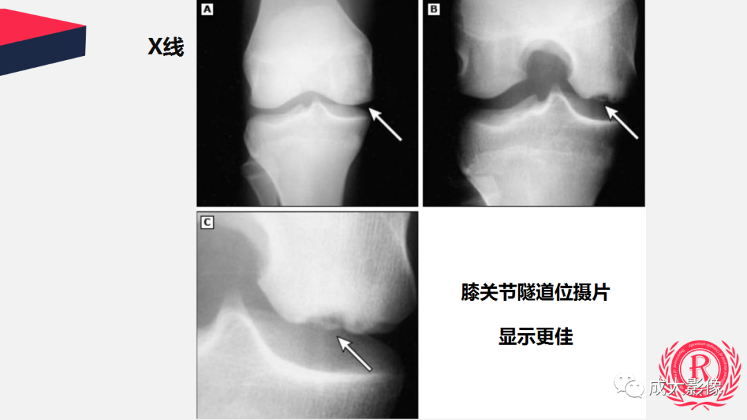 【PPT】剥脱性骨软骨炎-12