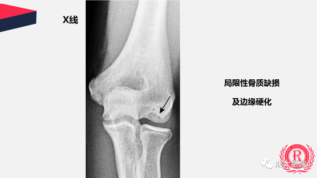 【PPT】剥脱性骨软骨炎-13