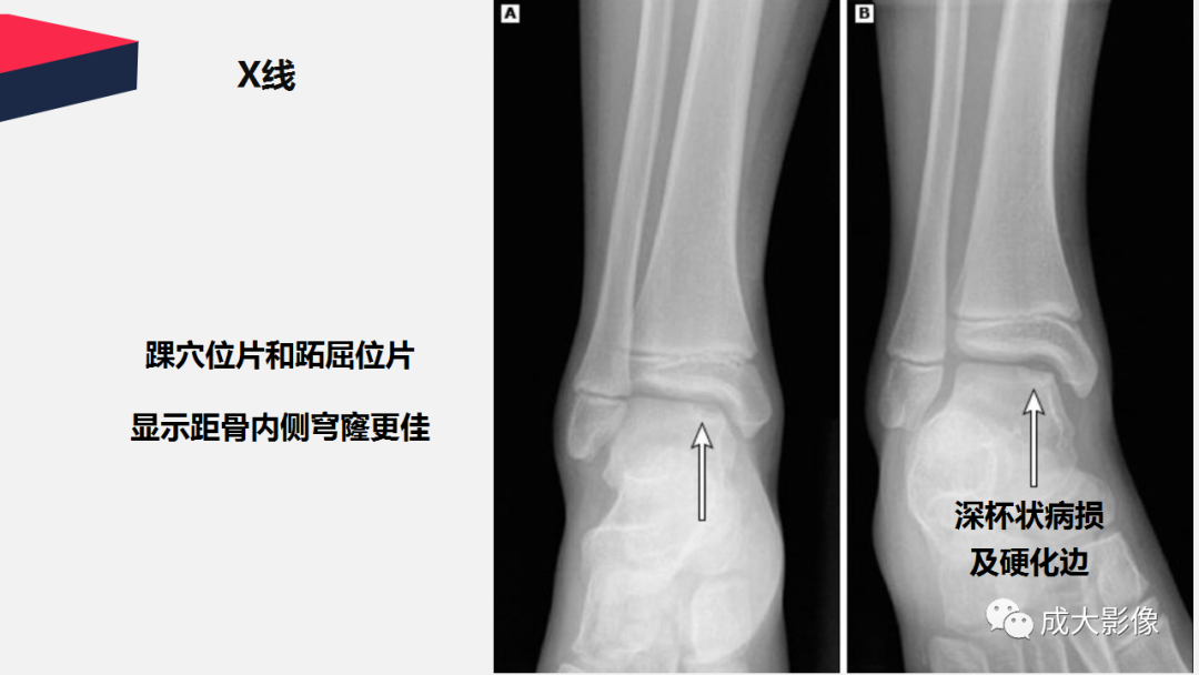 【PPT】剥脱性骨软骨炎-14