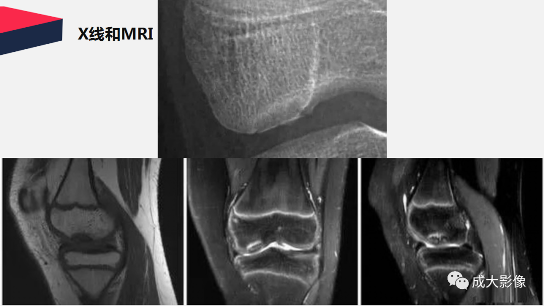 【PPT】剥脱性骨软骨炎-15