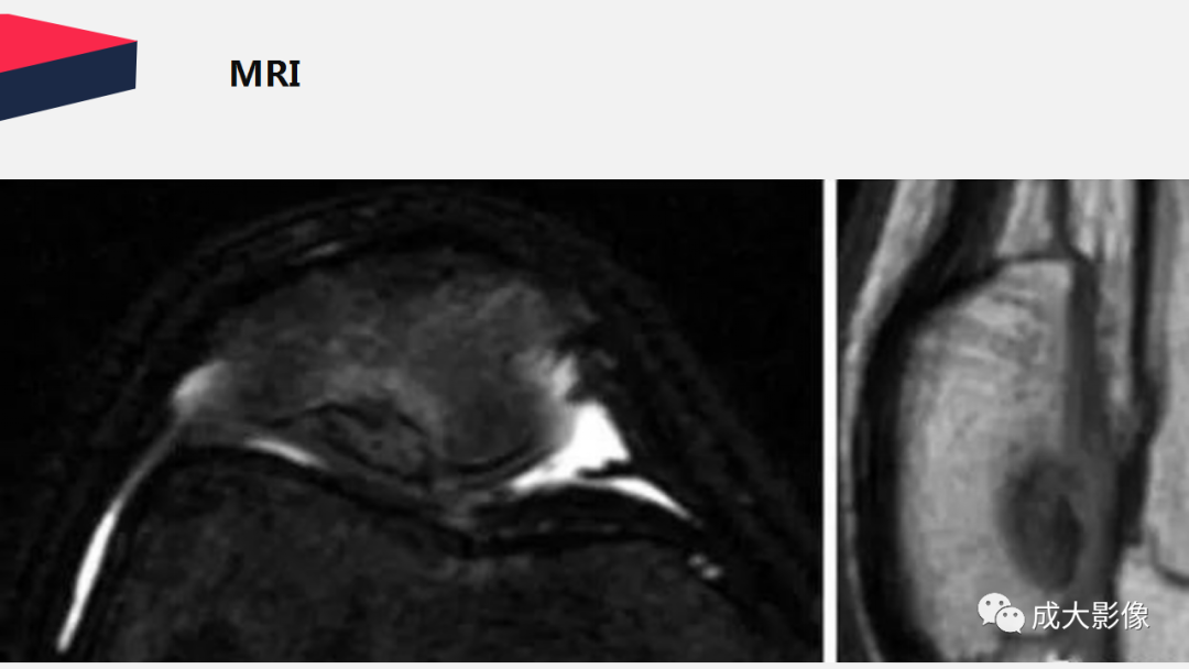 【PPT】剥脱性骨软骨炎-17